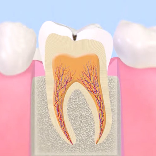 初期の虫歯（C1）