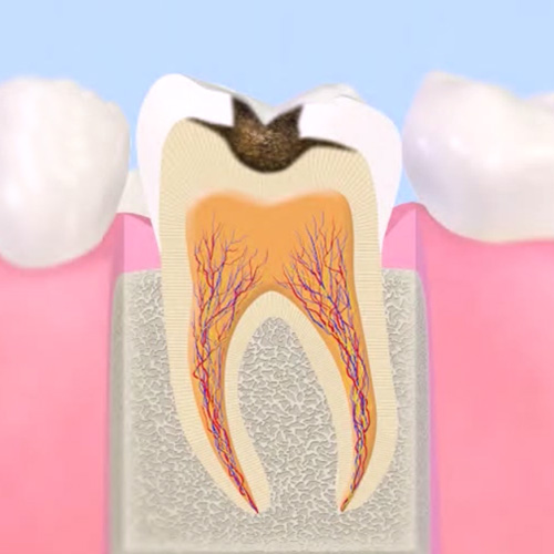 進行した虫歯（C2）
